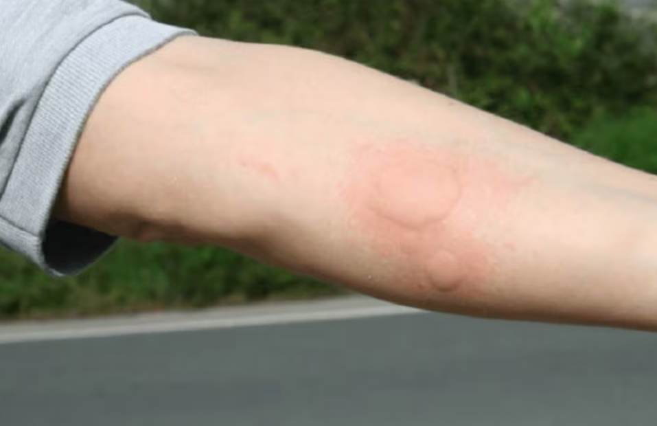 riesgo por picaduras de alacrán en Guanajuato