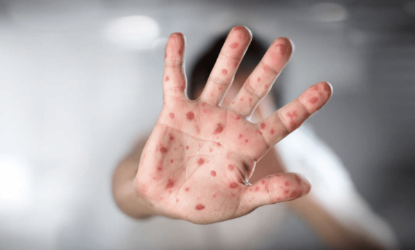 Personal Médico Realiza Revisión Sanitaria Ante Caso Confirmado De Sarampión En León.