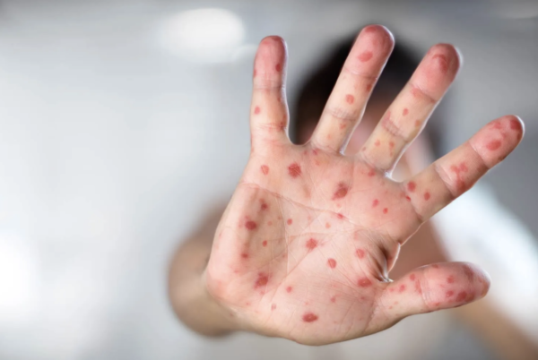 Secretaría de Salud de Guanajuato informa sobre casos de sarampión