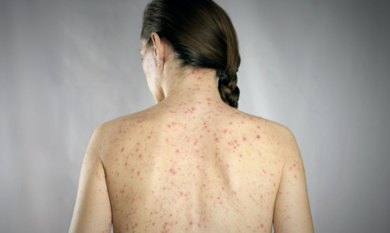 Alerta en Guanajuato: Autoridades prevén repunte de sarampión tras temporada vacacional
